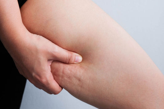 What is Cellulite?